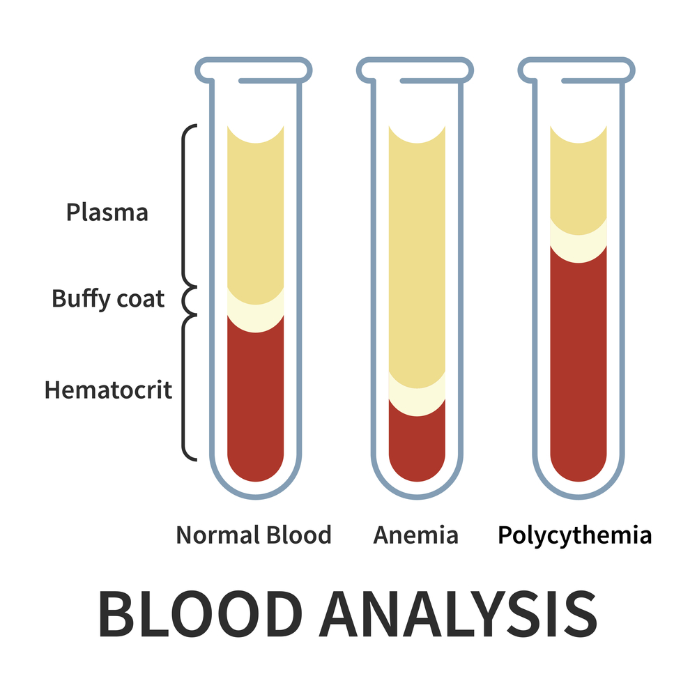 blood analysis, blood chemistry, blood clotting, blood clots, blood