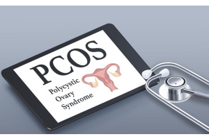 PCOS Quiz: Discover if You Have It