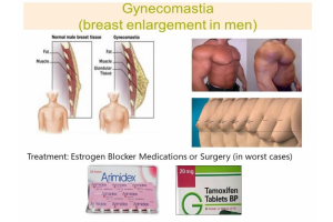 Understanding Gynecomastia Symptoms: Diagnosis and Treatments