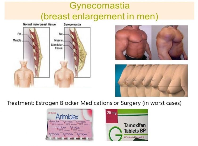 Gynecomastia Symptoms: Diagnosis and Treatment